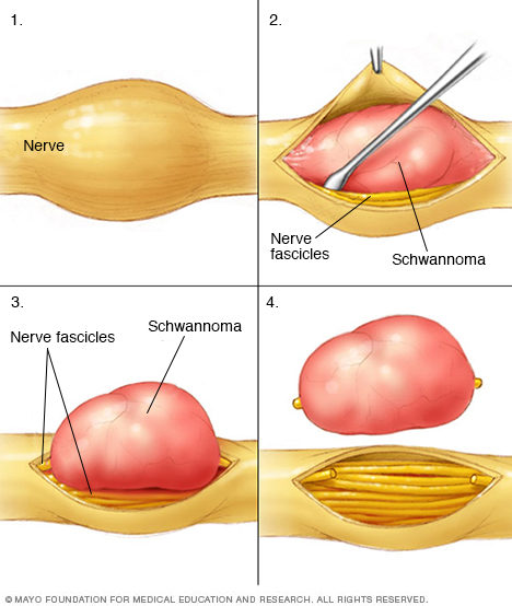 Schwannoma (u bao sợi thần kinh): Chẩn đoán và điều trị Schwannoma (u bao sợi thần kinh): Chẩn đoán và điều trị