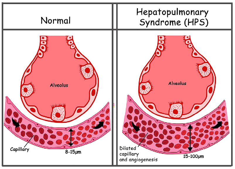 Hội chứng gan phổi là gì? Hội chứng gan phổi là gì?