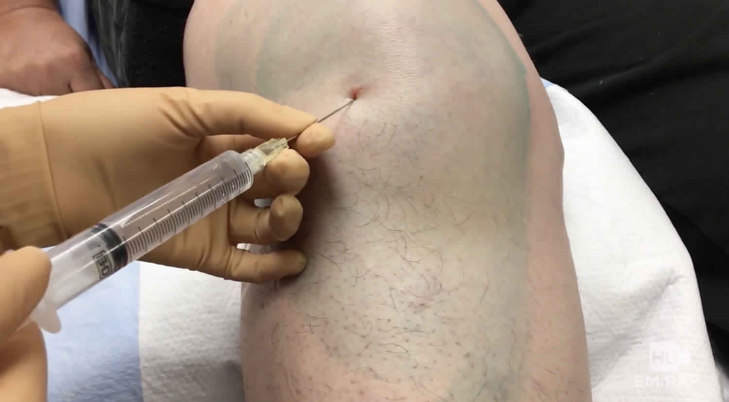 Thủ thuật chọc hút dịch khớp