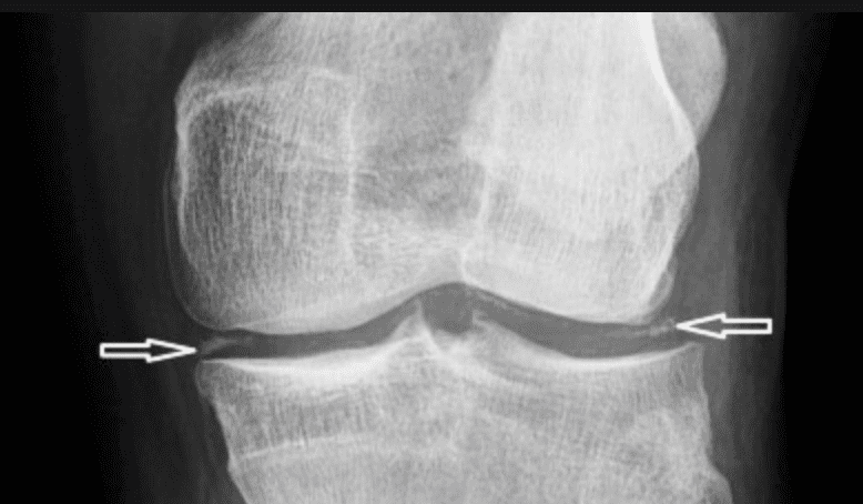 Phim chụp X-quang một khớp bị bệnh giả gout