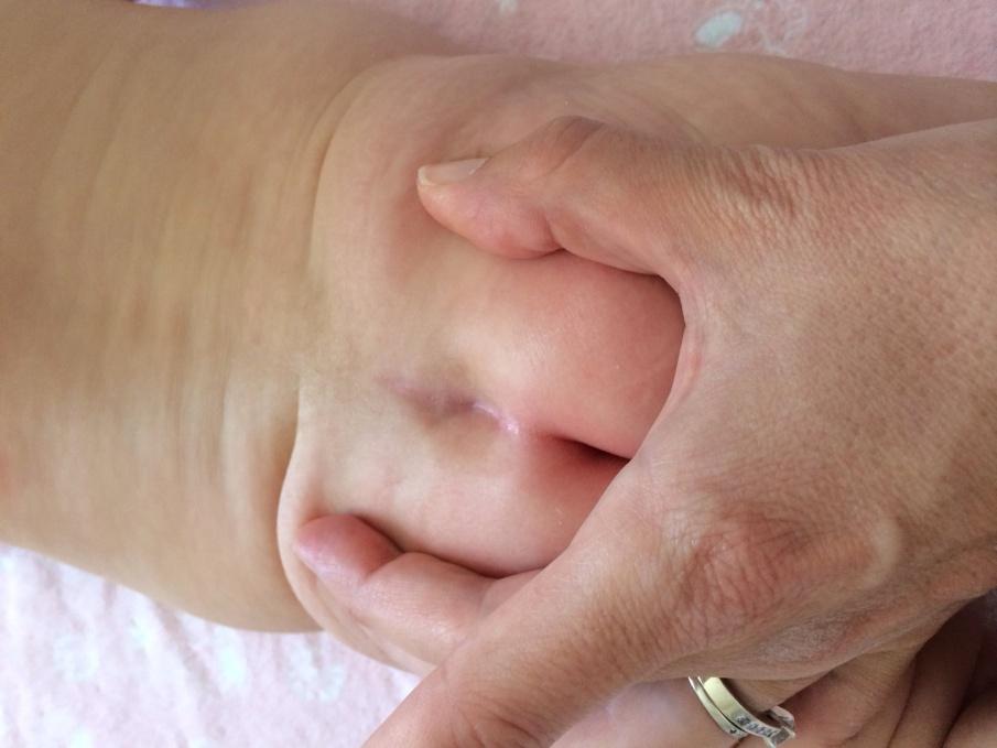 Vết lõm ở xương cùng, xuất hiện khi trẻ mới sinh