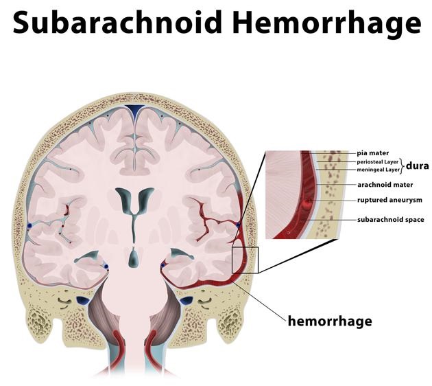 Xuất huyết dưới màng nhện: chẩn đoán và điều trị Xuất huyết dưới màng nhện: chẩn đoán và điều trị