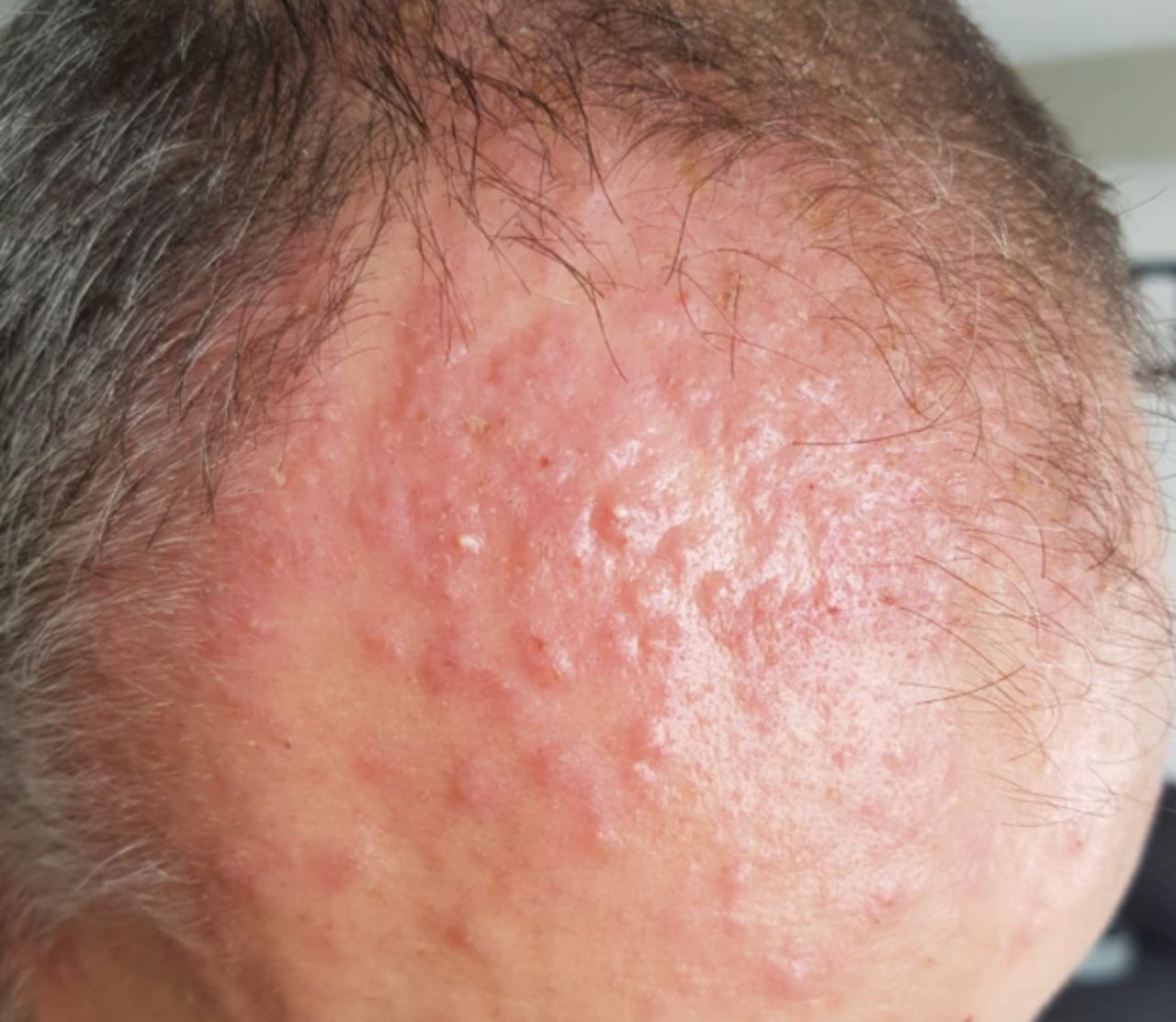 Hội chứng tăng bạch cầu ái toan Hội chứng tăng bạch cầu ái toan