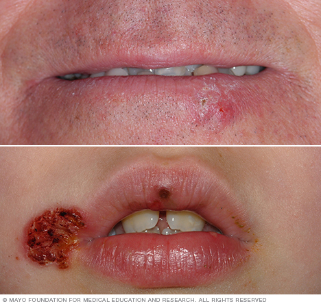 Mụn rộp (herpes) ở môi: nguyên nhân và điều trị Mụn rộp (herpes) ở môi: nguyên nhân và điều trị