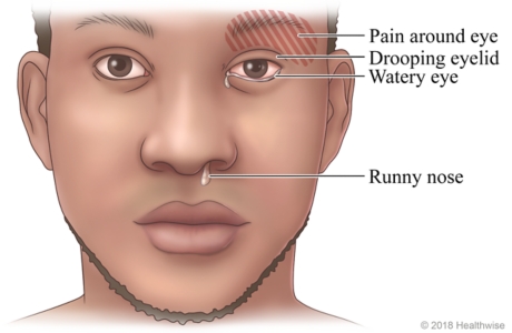 Nhức đầu cụm (cluster headaches)