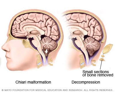 dị tật chiari
