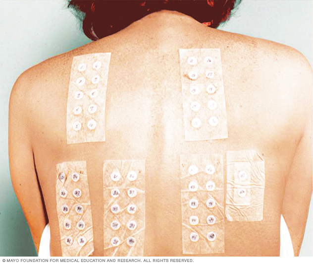 Xét nghiệm patch test