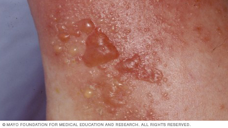 Phồng rộp do tiếp xúc với cây thường xuân độc