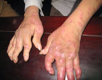 Các ngón tay bị biến dạng do viêm khớp vảy nến.