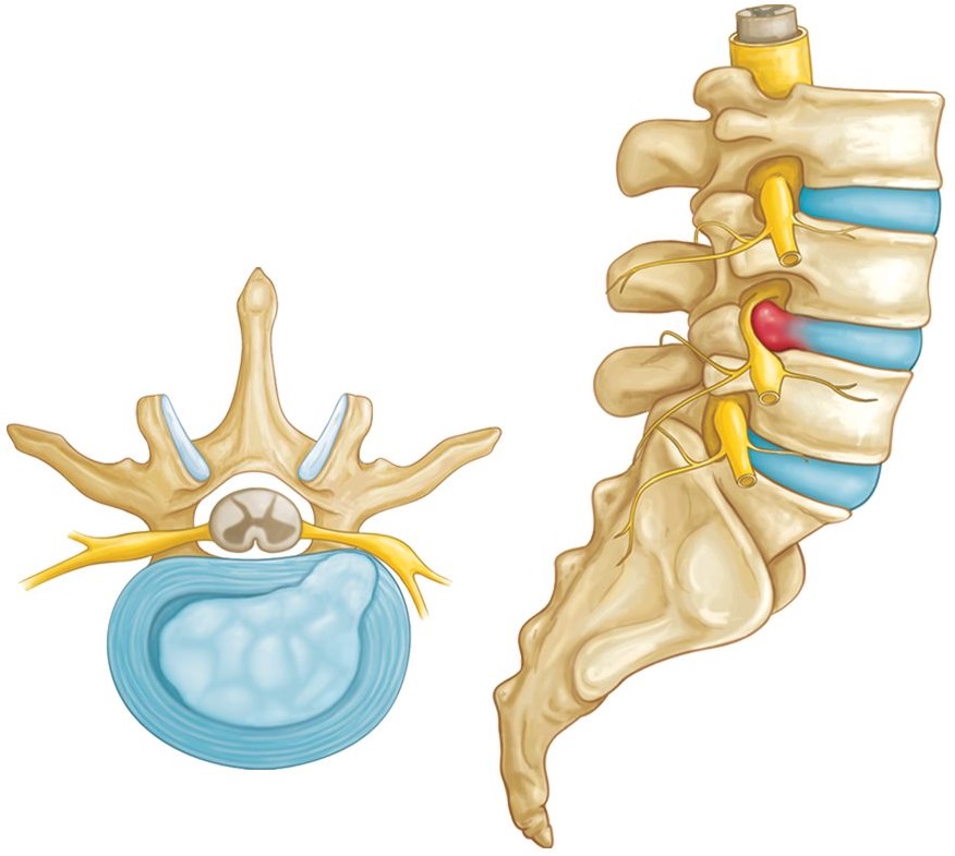 Thoát vị đĩa đệm ở lưng dưới