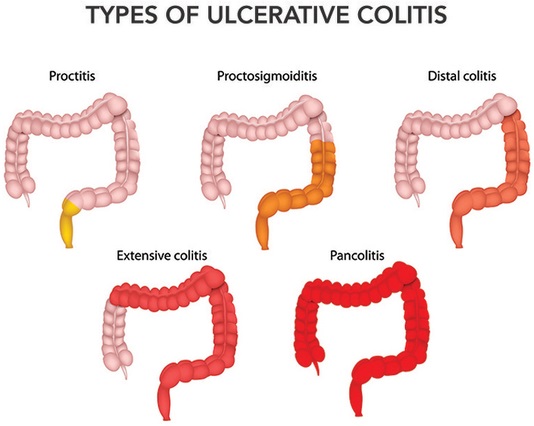 Các loại viêm loét đại tràng