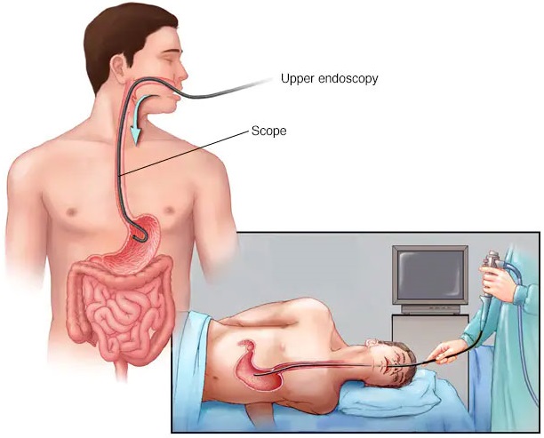 Nội soi đường tiêu hóa trên