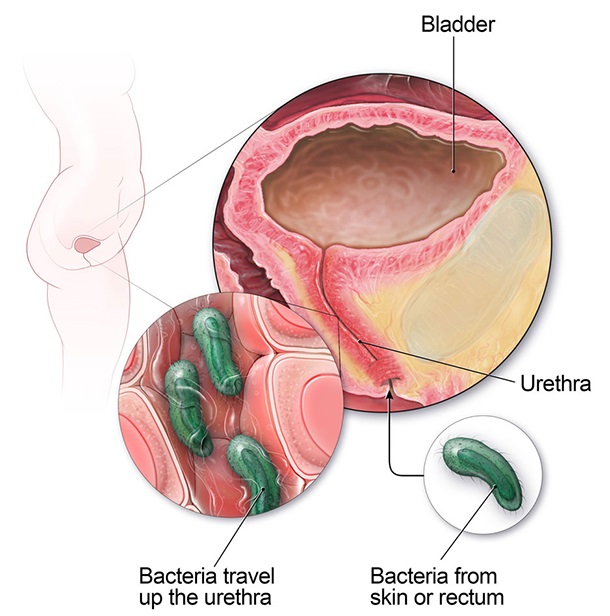 Nhiễm trùng đường tiết niệu ở phụ nữ