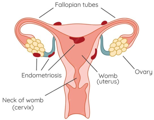 Cơn đau do lạc nội mạc tử cung thường xuất hiện ở đâu? Cơn đau do lạc nội mạc tử cung thường xuất hiện ở đâu?