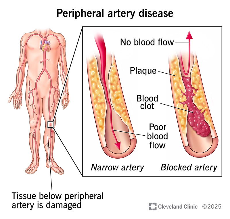 Bệnh động mạch ngoại biên
