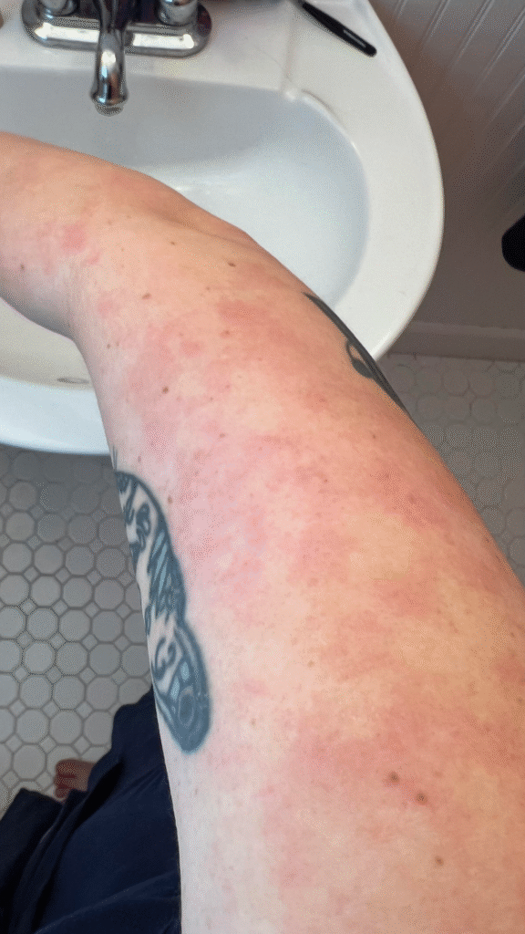 Phát ban da sau khi tiêm thuốc Humira