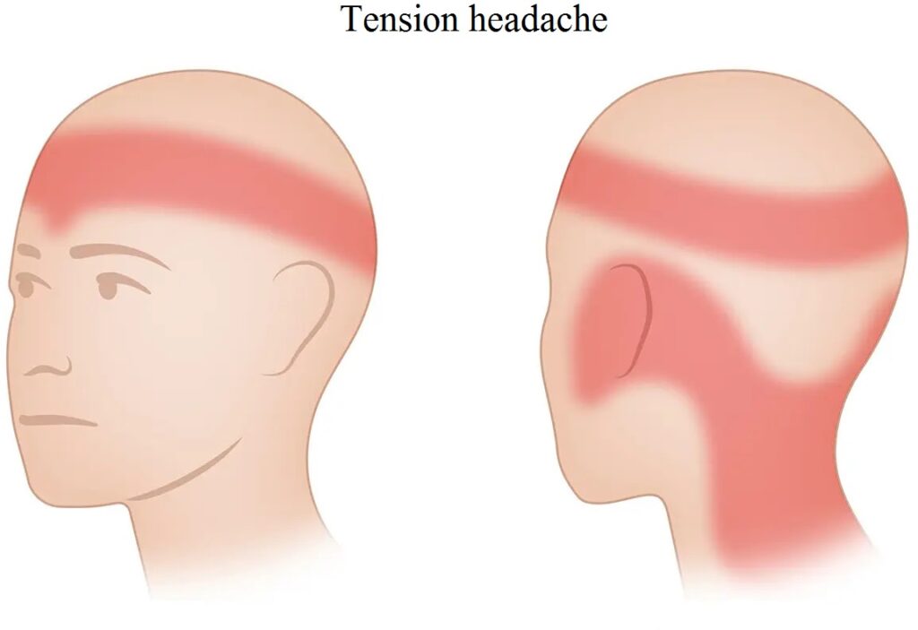 Đau đầu căng thẳng 